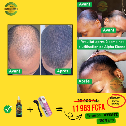 ALPHA ÉBÈNE – KIT ACCÉLÉRATEUR | Sérum Super Pousse + Derma Roller